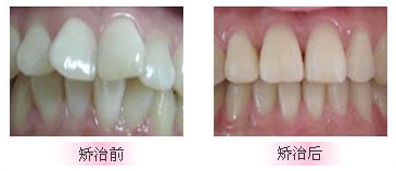 牙齿矫正的危害有哪些